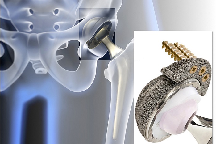 Ứng dụng in 3D trong y học để ghép xương, thay khớp nhân tạo